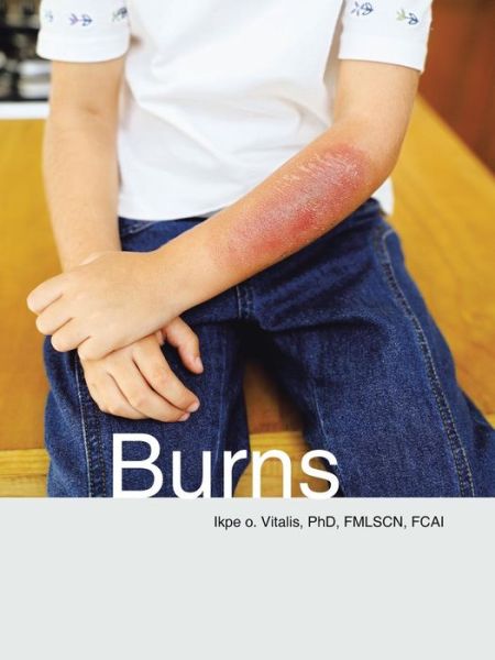 Cover for Vitalis, Phd Fmlscn, Fcai · Burns (Paperback Book) (2015)