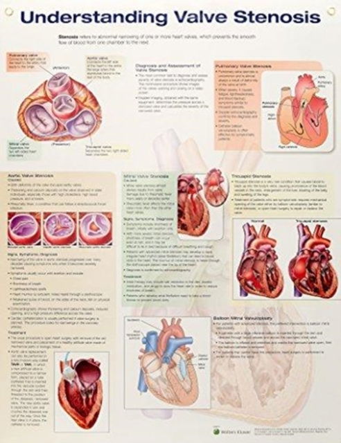 Understanding Valve Stenosis - Anatomical Chart Company - Marchandise - Lippincott Williams and Wilkins - 9781496369994 - 15 février 2018